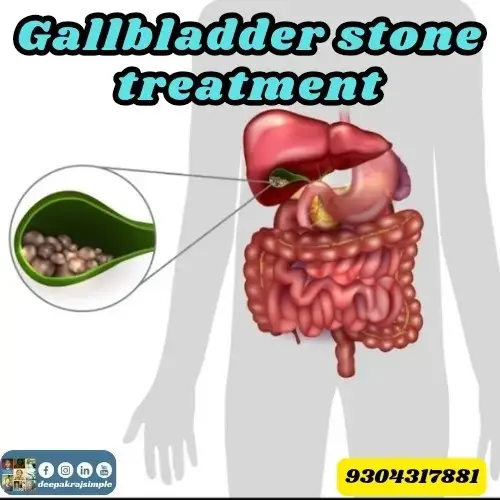 Gallbladder Stone Treatment Masterclass